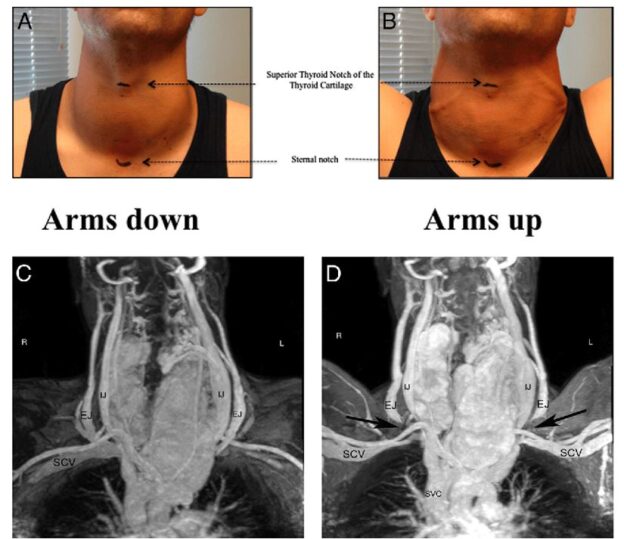 Eye Signs Of Thyroid Disease MyEndoConsult